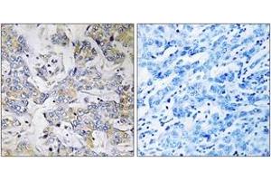 Immunohistochemistry analysis of paraffin-embedded human breast carcinoma tissue, using RPL37 Antibody. (RPL37 抗体  (AA 21-70))