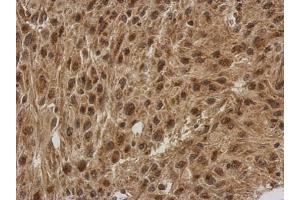 IHC-P Image Immunohistochemical analysis of paraffin-embedded U373 xenograft, using FGF13, antibody at 1:500 dilution. (FGF13 抗体)