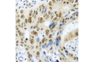 Immunohistochemical analysis of PSMA4 staining in human colon cancer formalin fixed paraffin embedded tissue section. (PSMA4 抗体)