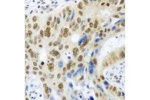 Immunohistochemical analysis of PSMA4 staining in human colon cancer formalin fixed paraffin embedded tissue section.