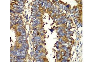 Immunohistochemistry of paraffin-embedded Human colon carcinoma using QARS Polyclonal Antibody at dilution of 1:100 (40x lens). (QARS 抗体)
