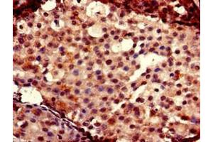 Immunohistochemistry of paraffin-embedded human breast cancer using ABIN7153026 at dilution of 1:100 (FOXC2 抗体  (AA 24-294))
