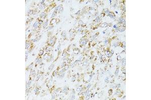 Immunohistochemistry of paraffin-embedded human lung cancer using EGFR antibody (ABIN6133679, ABIN6139975, ABIN6139980 and ABIN6215265) at dilution of 1:100 (40x lens).