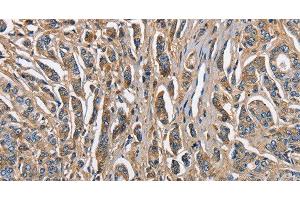 Immunohistochemistry of paraffin-embedded Human prostate cancer tissue using ABI3BP Polyclonal Antibody at dilution 1:60 (ABI3BP 抗体)