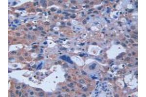 IHC-P analysis of Human Breast Cancer Tissue, with DAB staining. (Retinoic Acid Receptor alpha 抗体  (AA 68-173))