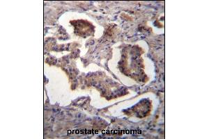 GUF1 Antibody (N-term) (ABIN656785 and ABIN2846003) immunohistochemistry analysis in formalin fixed and paraffin embedded human prostate carcinoma followed by peroxidase conjugation of the secondary antibody and DAB staining.