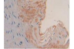 IHC-P analysis of Human Esophagus Cancer Tissue, with DAB staining. (SYK 抗体  (AA 374-635))