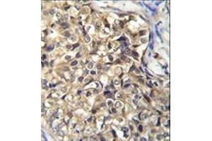 Immunohistochemistry analysis in formalin fixed and paraffin embedded human breast carcinoma reacted with KLHL35 Antibody (C-term) followed by peroxidase conjugation of the secondary antibody and DAB staining. (KLHL35 抗体  (C-Term))