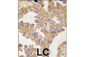 Formalin-fixed and paraffin-embedded human lung carcinoma tissue reacted with ACTB/ACTC antibody , which was peroxidase-conjugated to the secondary antibody, followed by DAB staining. (Actin 抗体  (N-Term))