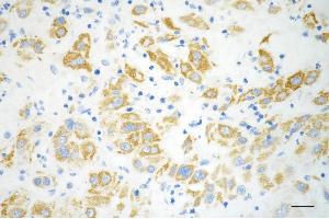 Immunohistochemistry was performed on paraffin-embedded human hepatocarcinoma using methylmalonyl-CoA mutase antibody (ABIN7799396), 1:200). (Recombinant MUT 抗体)