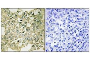 Immunohistochemical analysis of paraffin-embedded human breast carcinoma tissue using MYT1 (Phospho-Ser83) antibody (left)or the same antibody preincubated with blocking peptide (right). (PKMYT1 抗体  (pSer83))