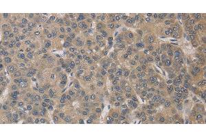 Immunohistochemistry of paraffin-embedded Human liver cancer tissue using ELOVL1 Polyclonal Antibody at dilution 1:30 (ELOVL1 抗体)