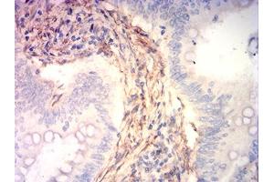 Immunohistochemical analysis of paraffin-embedded rectum cancer tissues using CNN3 mouse mAb with DAB staining. (CNN3 抗体  (AA 26-130))