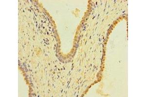 Immunohistochemistry of paraffin-embedded human prostate cancer using ABIN7157404 at dilution of 1:100 (KRT4 抗体  (AA 1-200))