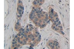 Detection of ATXN1 in Human Breast cancer Tissue using Polyclonal Antibody to Ataxin 1 (ATXN1) (Ataxin 1 抗体  (AA 569-807))