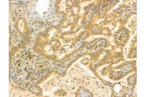 ABIN6259338 and ABIN6275436 at 1/100 staining Human lung cancer by IHC-P. (RAB3GAP2 抗体  (Internal Region))