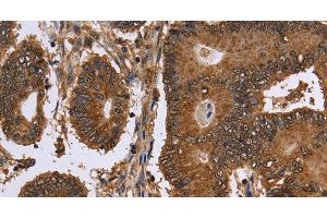 Immunohistochemistry of paraffin-embedded Human colon cancer tissue using FANCF Polyclonal Antibody at dilution 1:60 (FANCF 抗体)