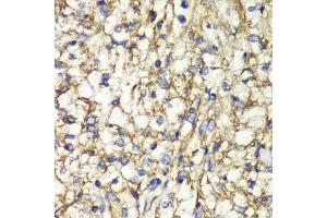Immunohistochemistry of paraffin-embedded human kidney cancer using PTGES2 antibody at dilution of 1:100 (x40 lens). (PTGES2 抗体)