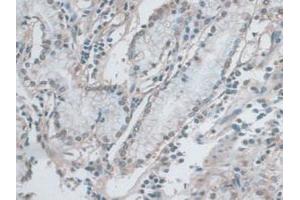 IHC-P analysis of Human Stomach Cancer Tissue, with DAB staining. (ERK1 抗体  (AA 75-312))