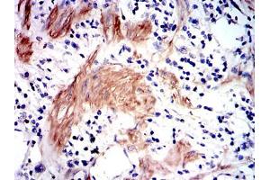 Immunohistochemical analysis of paraffin-embedded stomach cancer tissues using GSTM1 mouse mAb with DAB staining. (GSTM1 抗体)
