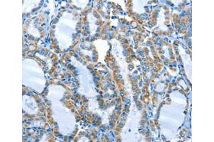 Immunohistochemical analysis of paraffin-embedded Human thyroid cancer tissue using at dilution 1/25. (ALPK1 抗体  (C-Term))
