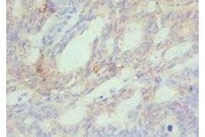 Immunohistochemistry of paraffin-embedded human colon cancer using ABIN7150954 at dilution of 1:100 (CBX4 抗体  (AA 401-560))