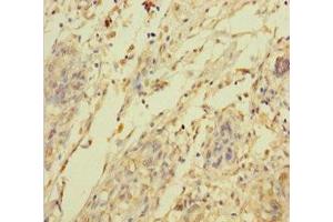 Immunohistochemistry of paraffin-embedded human pancreatic cancer using ABIN7144705 at dilution of 1:100 (C2orf49 抗体  (AA 1-232))