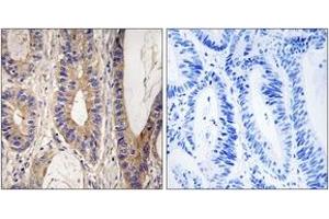 Immunohistochemistry analysis of paraffin-embedded human colon carcinoma tissue, using UPF1 Antibody. (RENT1/UPF1 抗体  (AA 299-348))