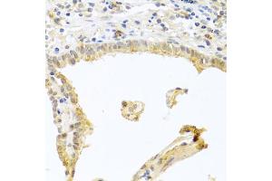 Immunohistochemistry of paraffin-embedded human lung cancer using PRKCA antibody (ABIN5970097) at dilution of 1/100 (40x lens).