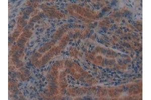 IHC-P analysis of Human Thyroid cancer Tissue, with DAB staining. (GPX4 抗体  (AA 74-197))