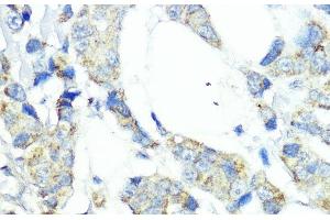 Immunohistochemistry of paraffin-embedded Human mammary cancer using NOD1 Polyclonal Antibody at dilution of 1:100 (40x lens). (NOD1 抗体)