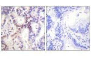 Immunohistochemical analysis of paraffin-embedded human lung carcinoma tissue using p15 INK antibody. (CDKN2B 抗体)