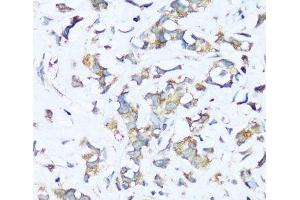 Immunohistochemistry of paraffin-embedded Human breast cancer using ATP5I Polyclonal Antibody at dilution of 1:100 (40x lens). (ATP5I 抗体)