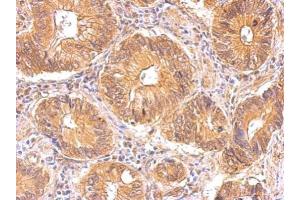 IHC-P Image Insulin Receptor antibody detects INSR protein at cytosol on human gastric cancer by immunohistochemical analysis. (Insulin Receptor 抗体  (C-Term))