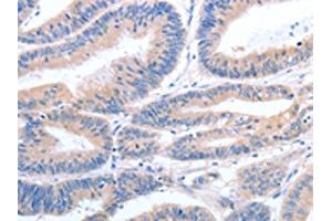 The image on the left is immunohistochemistry of paraffin-embedded Human colon cancer tissue using ABIN7190789(GFRA4 Antibody) at dilution 1/40, on the right is treated with synthetic peptide. (GFRA4 抗体)