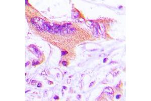 Immunohistochemical analysis of NIP1 staining in human lung cancer formalin fixed paraffin embedded tissue section. (BNIP1 抗体  (C-Term))