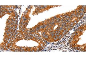 Immunohistochemistry of paraffin-embedded Human cervical cancer tissue using FGFR1 Polyclonal Antibody at dilution 1:60 (FGFR1 抗体)