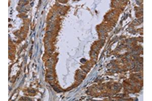 The image on the left is immunohistochemistry of paraffin-embedded Human esophagus cancer tissue using ABIN7129900(INSIG2 Antibody) at dilution 1/30, on the right is treated with fusion protein. (INSIG2 抗体)