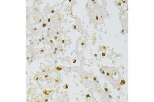 Immunohistochemistry of paraffin-embedded human brain astrocytoma using HNRNPA1 Antibody (ABIN5975570) at dilution of 1/100 (40x lens). (HNRNPA1 抗体)