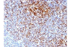 Formalin-fixed, paraffin-embedded human Follicular Lymphoma stained with Bcl-2 Rabbit Recombinant Monoclonal Antibody (BCL2/2210R). (Recombinant Bcl-2 抗体)