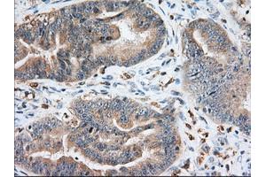 Immunohistochemical staining of paraffin-embedded Adenocarcinoma of Human colon tissue using anti-IGF2BP2 mouse monoclonal antibody. (IGF2BP2 抗体)