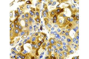 Immunohistochemistry of paraffin-embedded Human liver cancer using CDK20 Polyclonal Antibody at dilution of 1:100 (40x lens). (CCRK 抗体)
