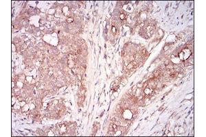Immunohistochemical analysis of paraffin-embedded cervical cancer tissues using MSTN mouse mAb with DAB staining. (MSTN 抗体  (AA 24-266))