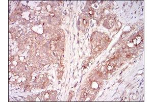 Immunohistochemical analysis of paraffin-embedded cervical cancer tissues using MSTN mouse mAb with DAB staining.