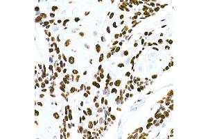 Immunohistochemistry of paraffin-embedded human esophageal cancer using HNRNPM Rabbit mAb (ABIN7267635) at dilution of 1:100 (40x lens). (HNRNPM 抗体)