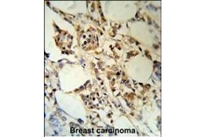 RBM3 Antibody (C-term) (R) IHC analysis in formalin fixed and paraffin embedded human breast carcinoma followed by peroxidase conjugation of the secondary antibody and DAB staining. (RBM3 抗体  (C-Term))