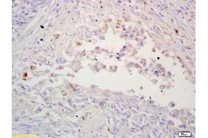 Formalin-fixed and paraffin embedded human lung carcinoma labeled with Rabbit Anti LRP/MVP Polyclonal Antibody, Unconjugated (ABIN671586) at 1:200 followed by conjugation to the secondary antibody and DAB staining (MVP 抗体  (AA 88-180))