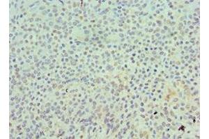 Immunohistochemistry of paraffin-embedded human breast cancer using ABIN7168550 at dilution of 1:100 (SKP1 抗体  (AA 1-163))