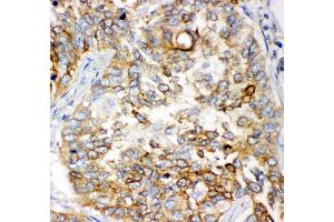 Anti- GCLC antibody, IHC(P) IHC(P): Human Lung Cancer Tissue (GCLC 抗体  (AA 437-637))