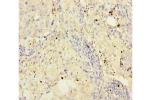 Immunohistochemistry of paraffin-embedded human lung cancer using ABIN7152960 at dilution of 1:100 (FKBPL 抗体  (AA 1-349))